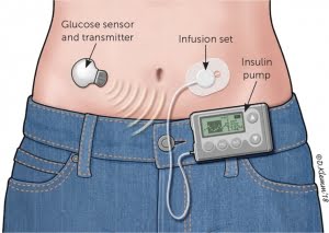 Insulin_Pumps